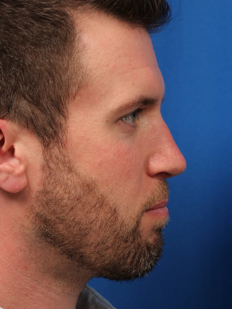 Male Cosmetic Rhinoplasty