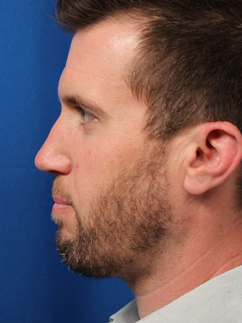 Male Cosmetic Rhinoplasty