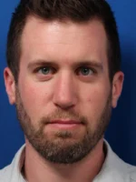 Male Cosmetic Rhinoplasty