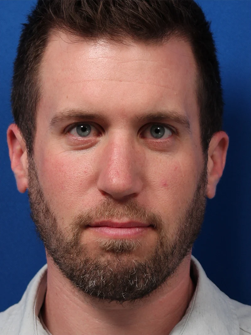 Male Cosmetic Rhinoplasty