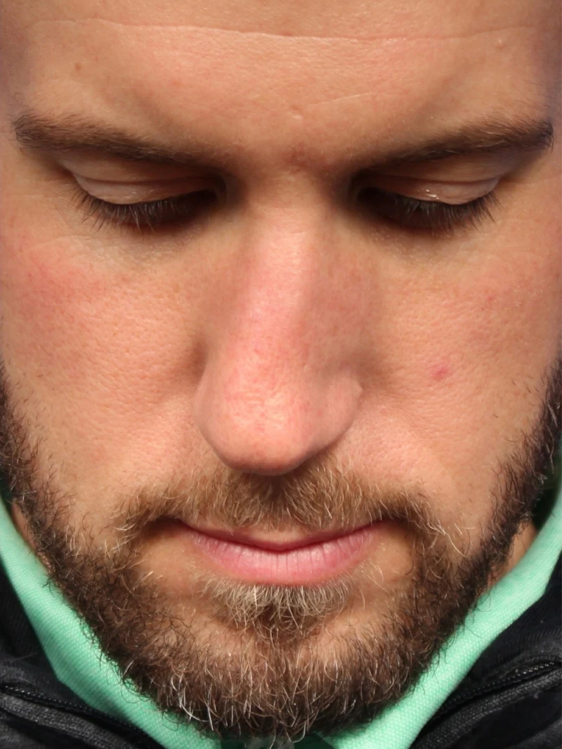 Male Cosmetic Rhinoplasty