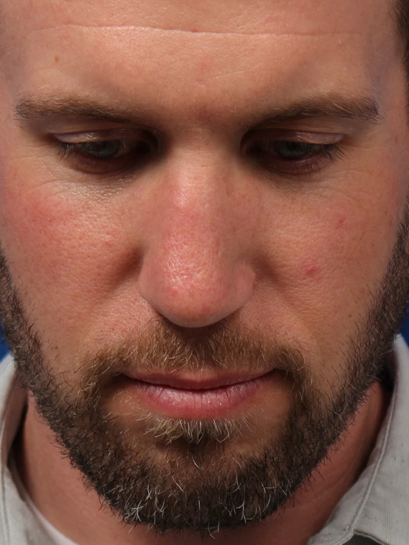 Male Cosmetic Rhinoplasty