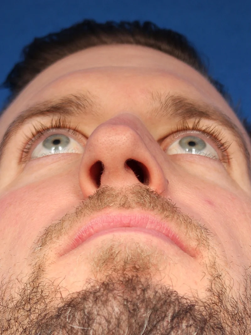 Male Cosmetic Rhinoplasty