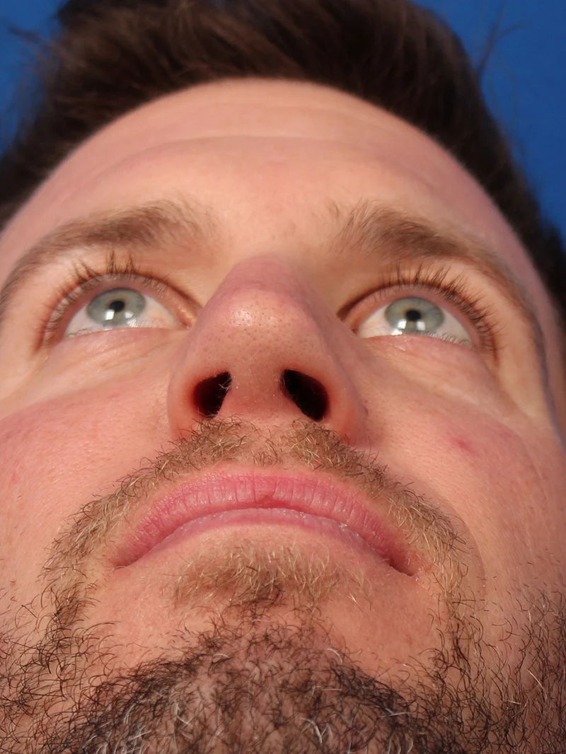 Male Cosmetic Rhinoplasty