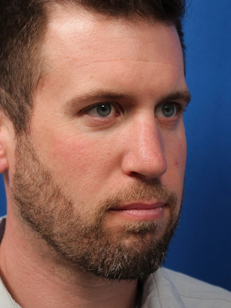 Male Cosmetic Rhinoplasty