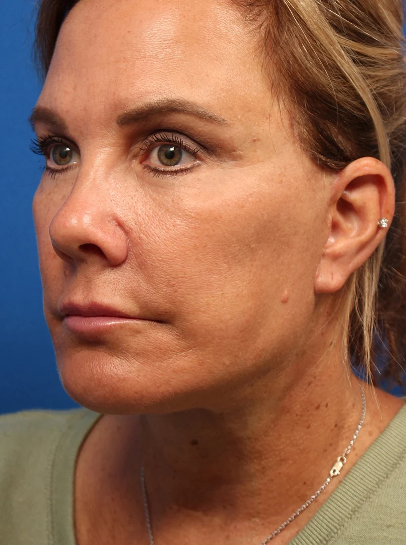 Vertical Vector Facelift