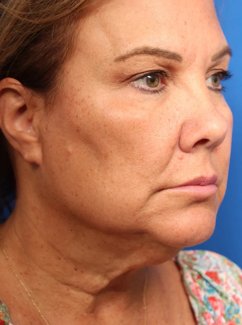 Vertical Vector Facelift