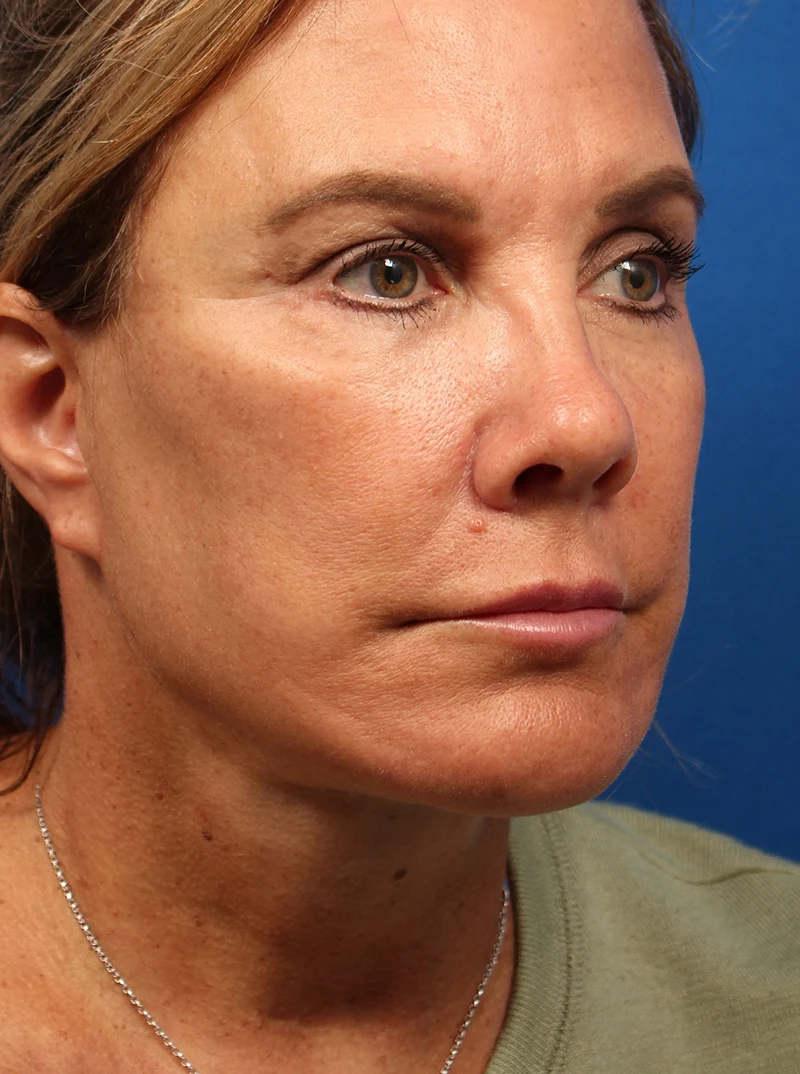 Vertical Vector Facelift