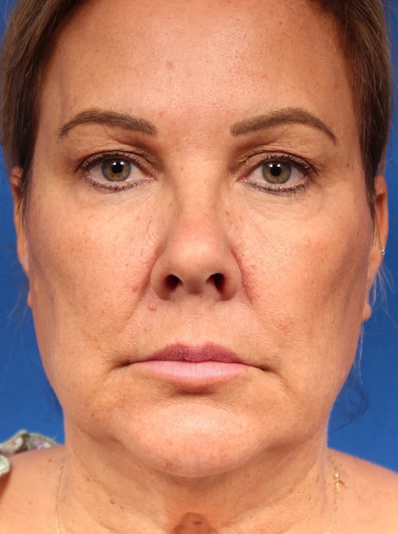 Vertical Vector Facelift