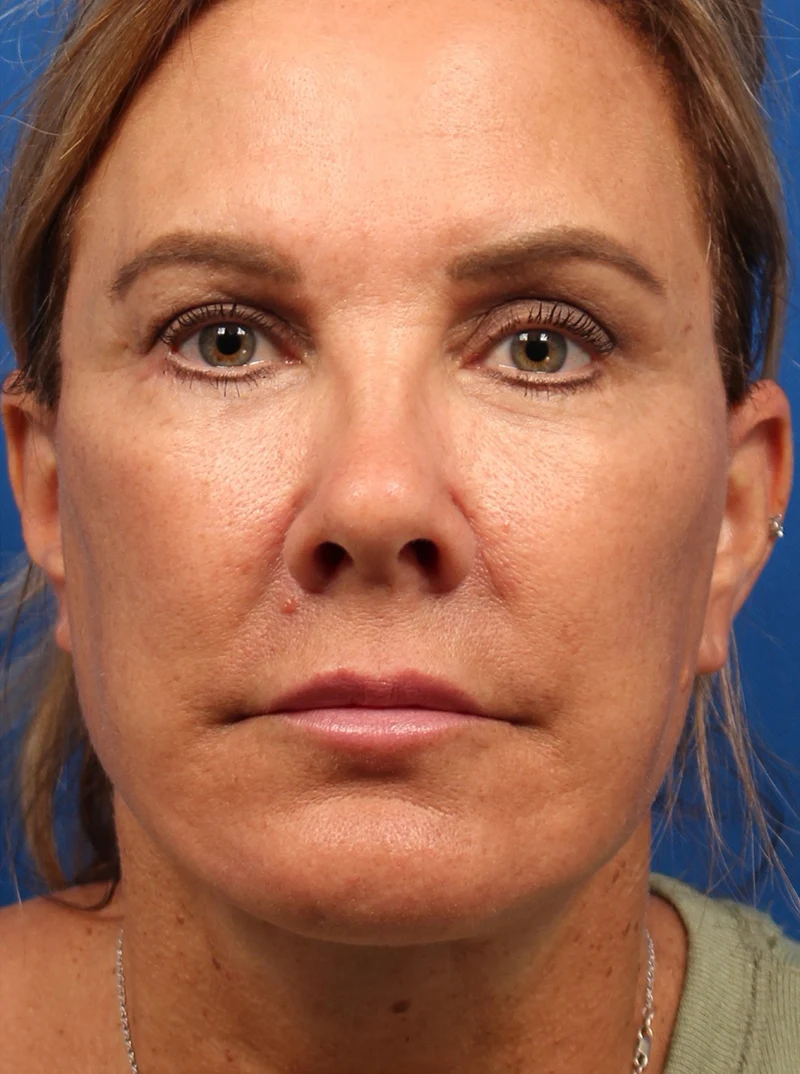 Vertical Vector Facelift