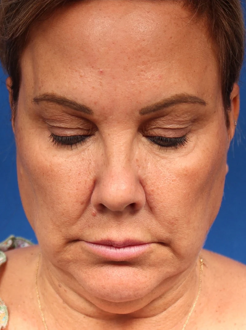 Vertical Vector Facelift
