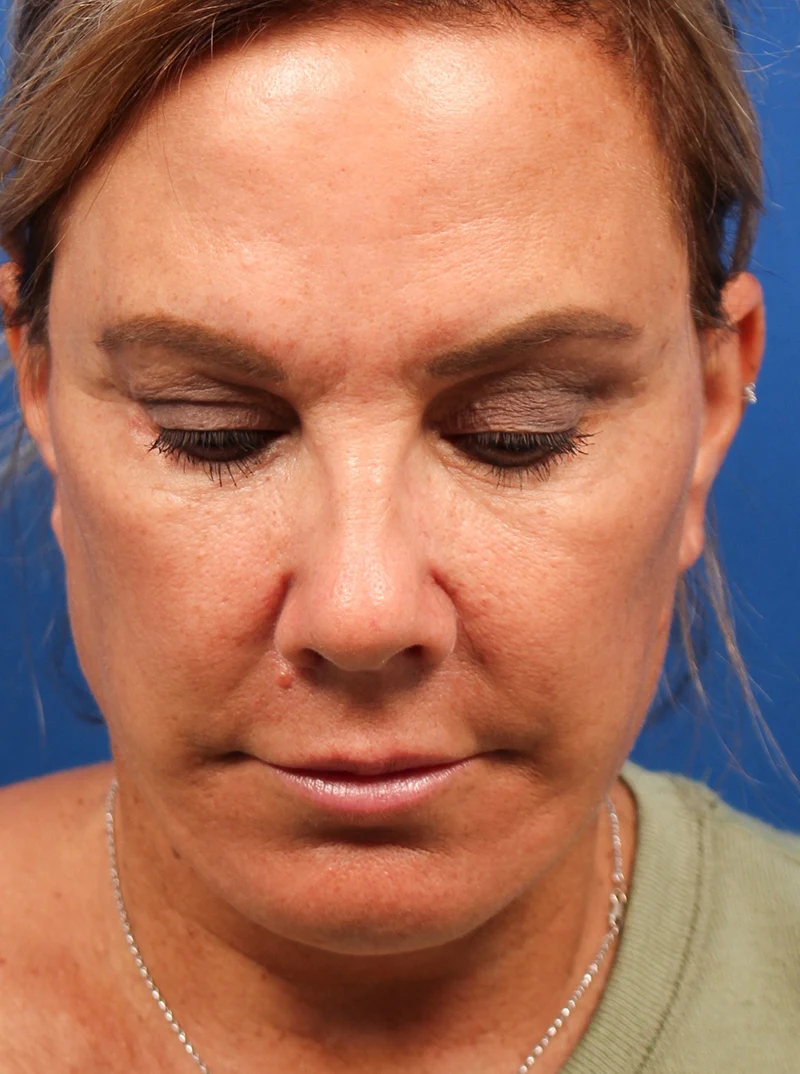 Vertical Vector Facelift