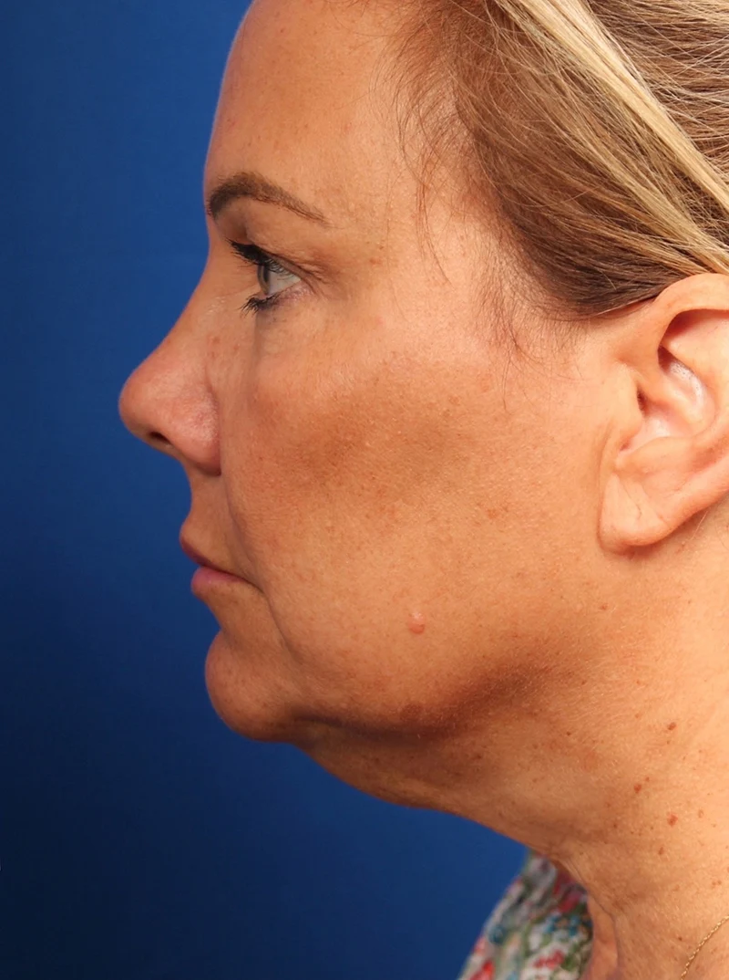 Vertical Vector Facelift