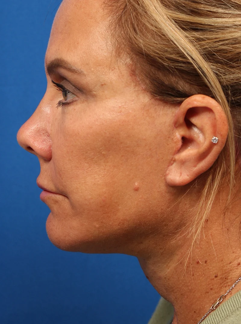 Vertical Vector Facelift