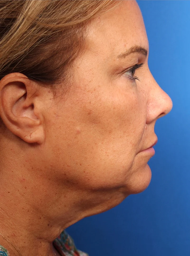 Vertical Vector Facelift