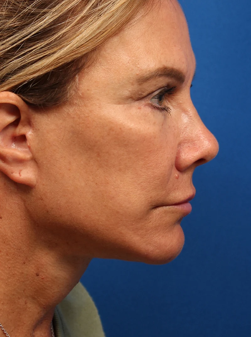 Vertical Vector Facelift