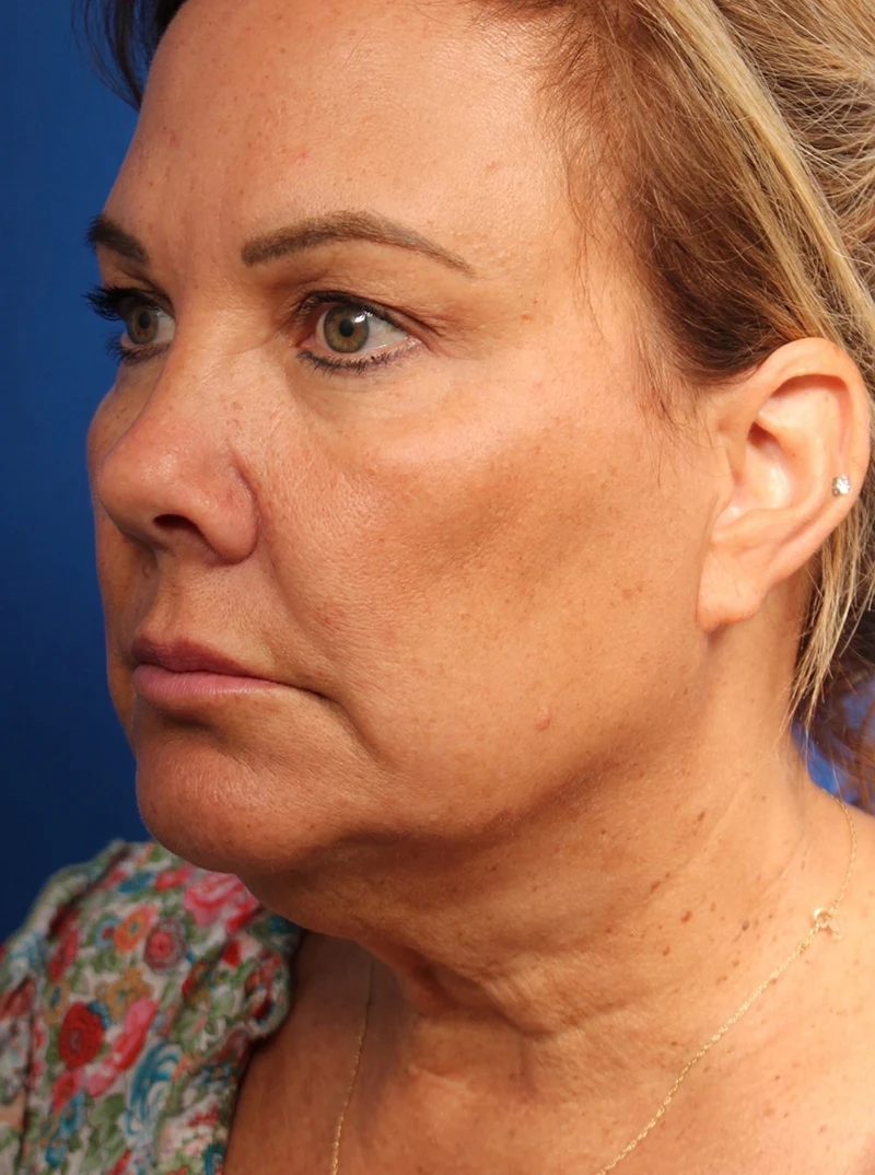 Vertical Vector Facelift