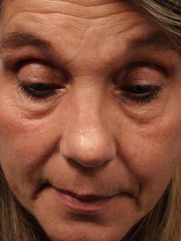 Female Revision Rhinoplasty