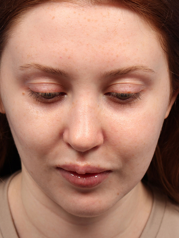 Female Cosmetic Rhinoplasty