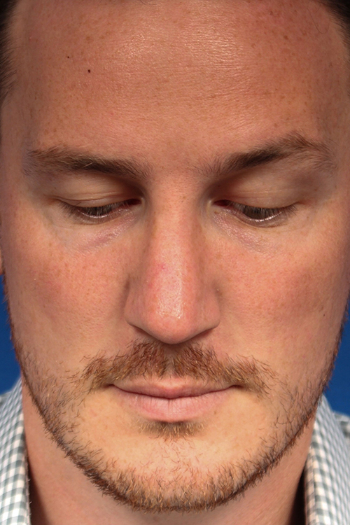 Male Cosmetic Rhinoplasty