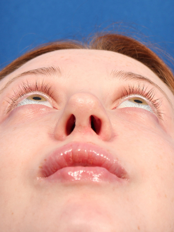 Female Cosmetic Rhinoplasty