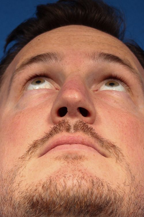 Male Cosmetic Rhinoplasty