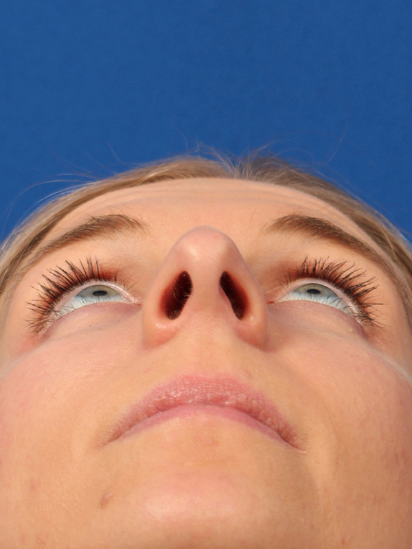 Female Cosmetic Rhinoplasty