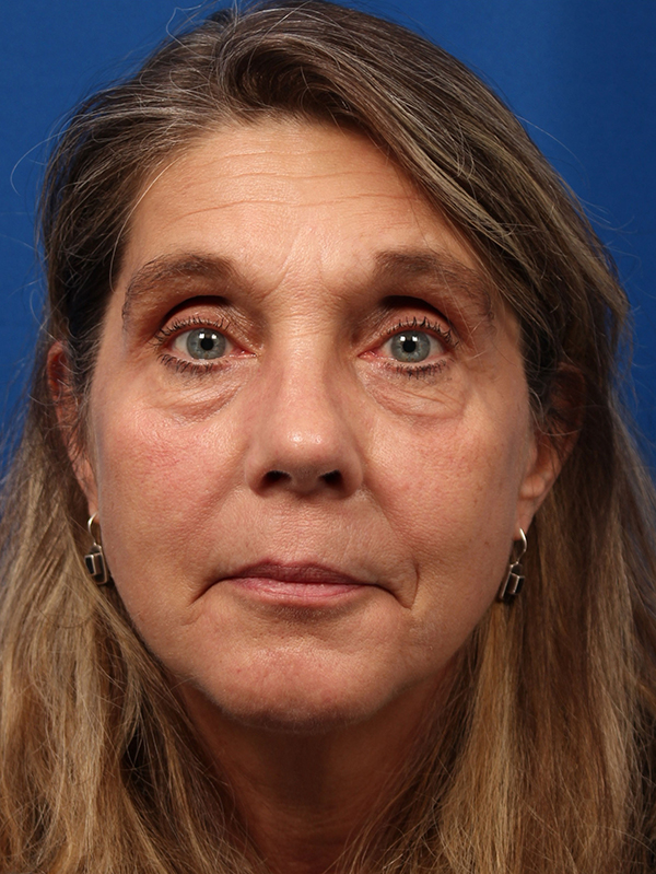 Female Revision Rhinoplasty