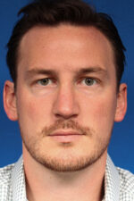 Male Cosmetic Rhinoplasty