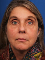 Female Revision Rhinoplasty