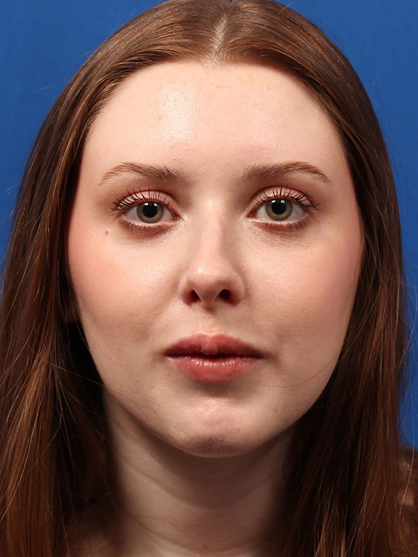 Female Cosmetic Rhinoplasty