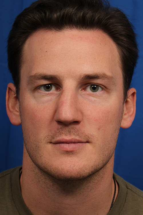 Male Cosmetic Rhinoplasty