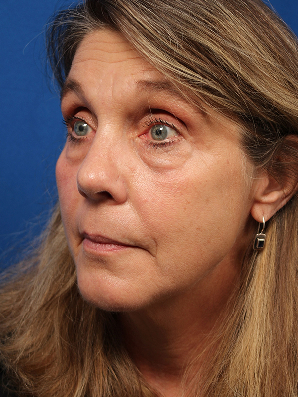 Female Revision Rhinoplasty