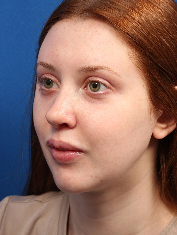 Female Cosmetic Rhinoplasty