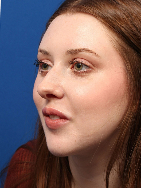 Female Cosmetic Rhinoplasty