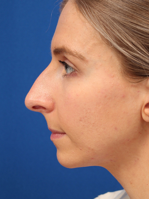 Female Cosmetic Rhinoplasty