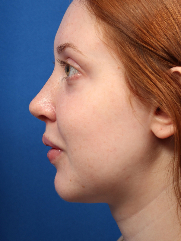 Female Cosmetic Rhinoplasty