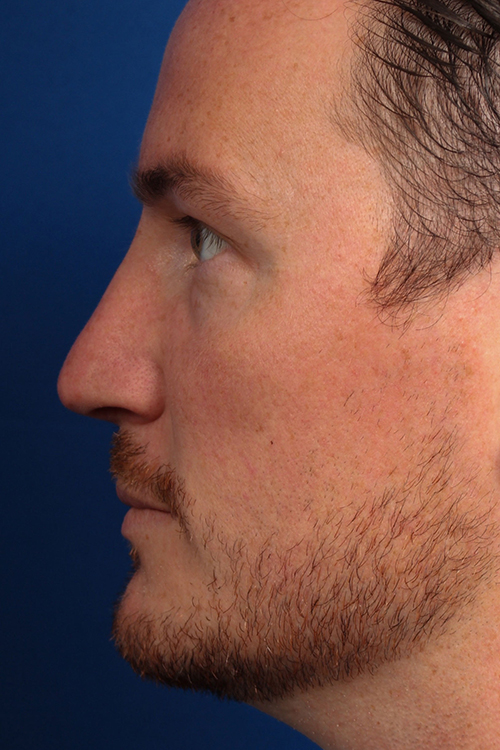 Male Cosmetic Rhinoplasty