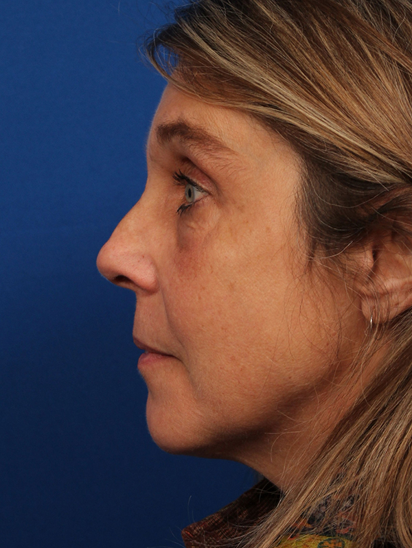 Female Revision Rhinoplasty