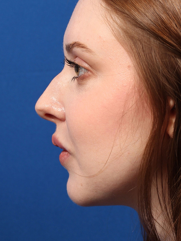 Female Cosmetic Rhinoplasty