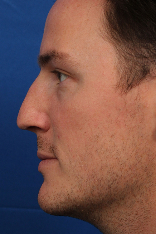 Male Cosmetic Rhinoplasty