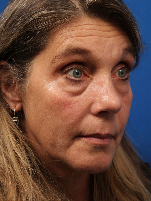 Female Revision Rhinoplasty