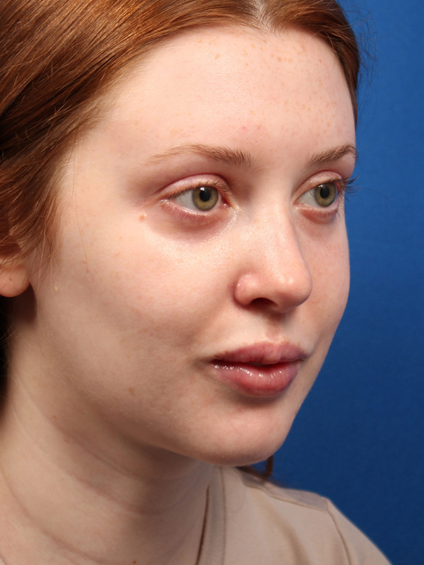 Female Cosmetic Rhinoplasty