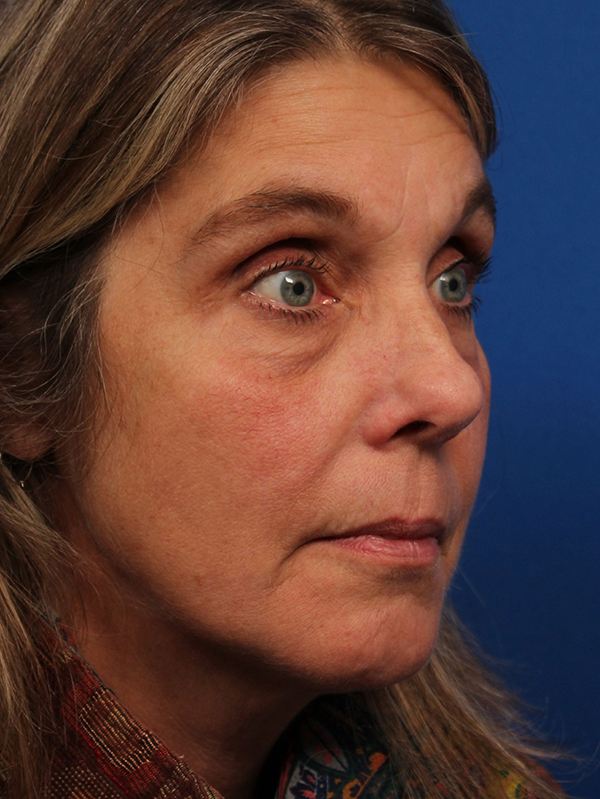 Female Revision Rhinoplasty