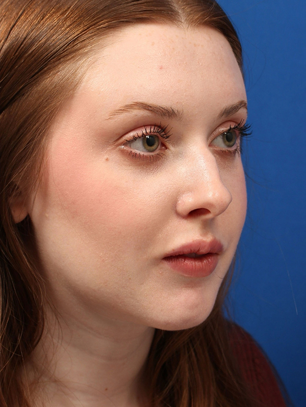 Female Cosmetic Rhinoplasty