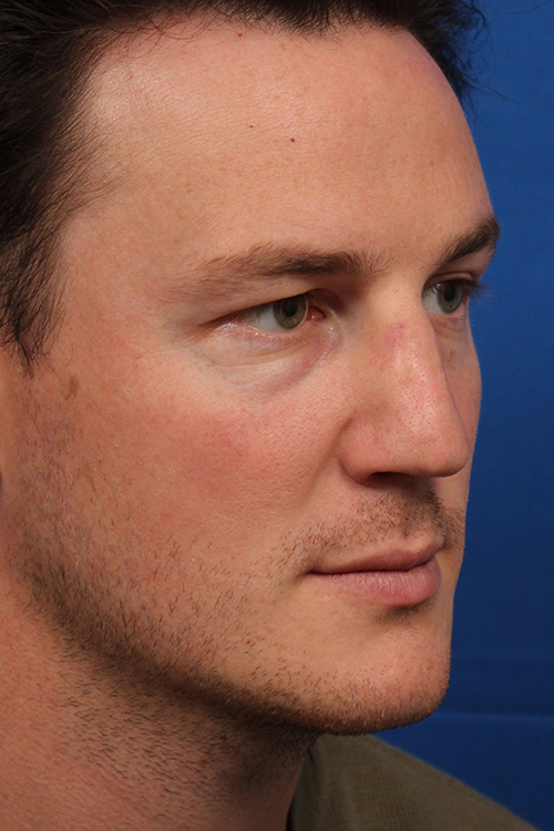 Male Cosmetic Rhinoplasty