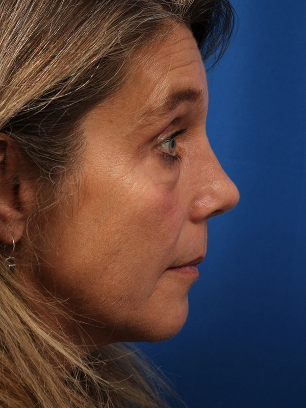 Female Revision Rhinoplasty