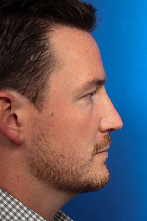 Male Cosmetic Rhinoplasty