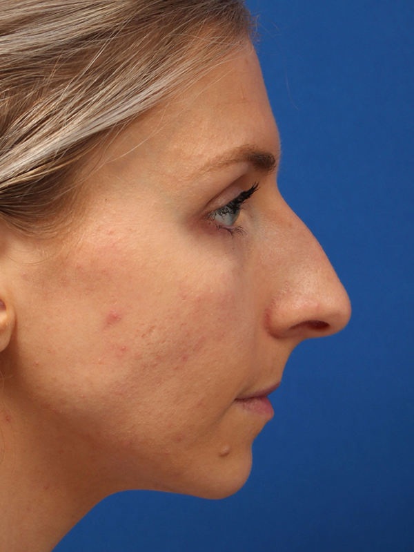 Female Cosmetic Rhinoplasty