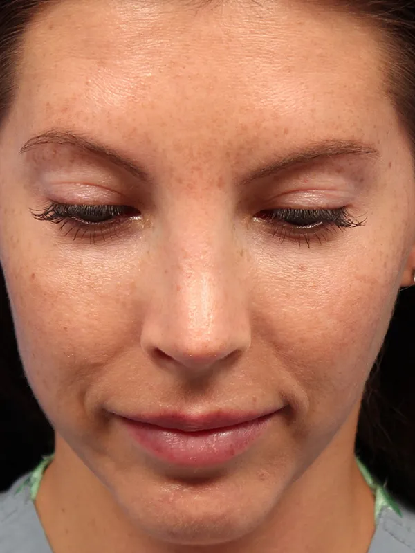 Female Cosmetic Rhinoplasty